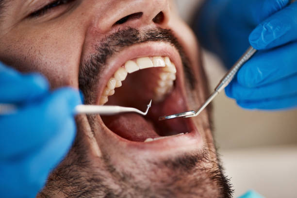 Best Knocked-Out Tooth (Avulsed Tooth) Treatment in Grove, OK