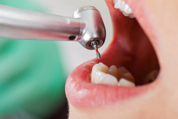 Best Lost Filling or Crown Replacement in Grove, OK